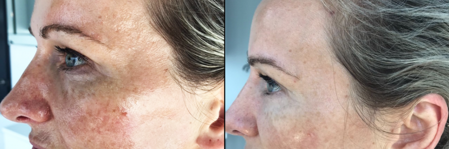 Result after 8 weeks of AnteAGE